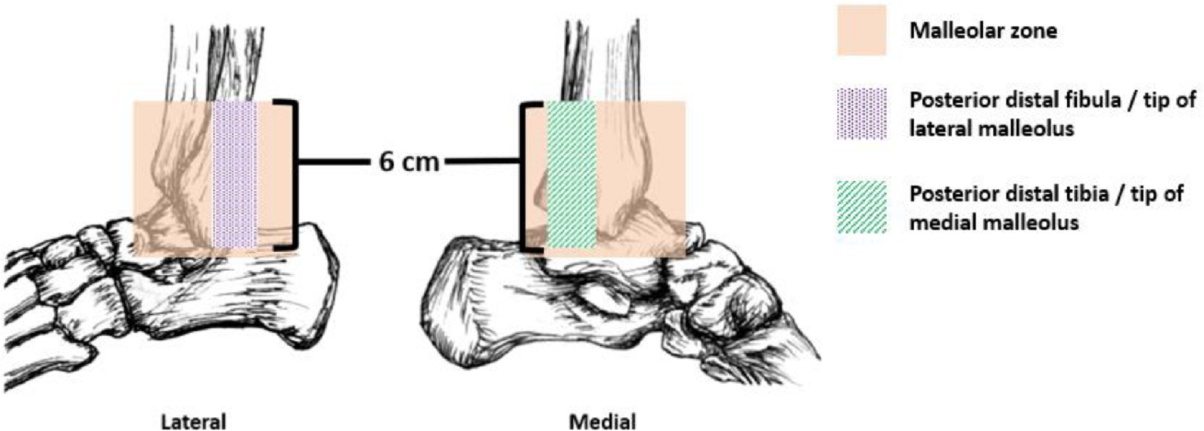 渥太華足踝準則 (Ottawa Ankle Rules) 指引圖
