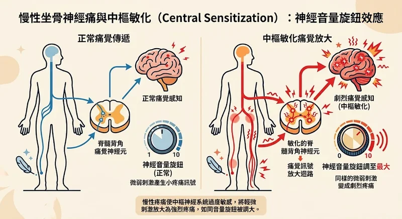 慢性坐骨神經痛中樞敏化與神經音量旋鈕放大效應圖